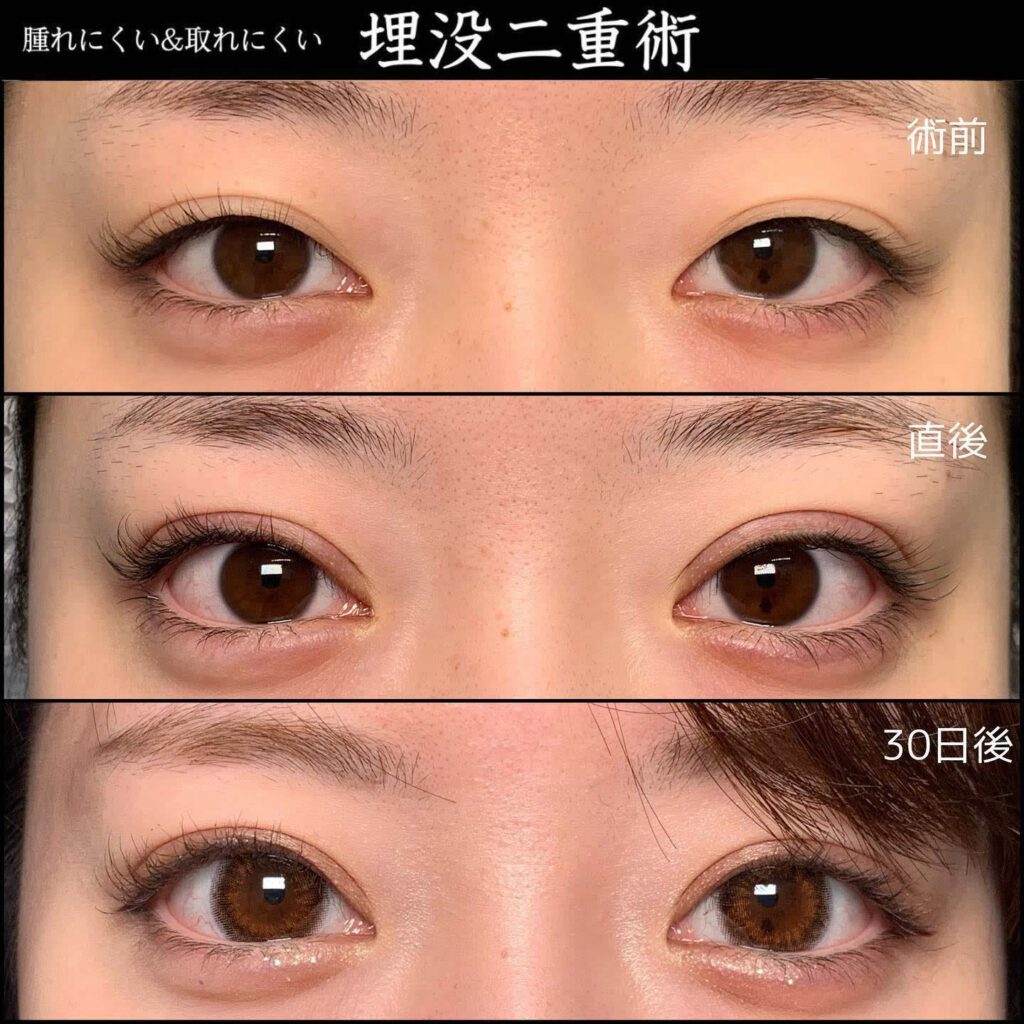 埋没法の経過の症例写真
