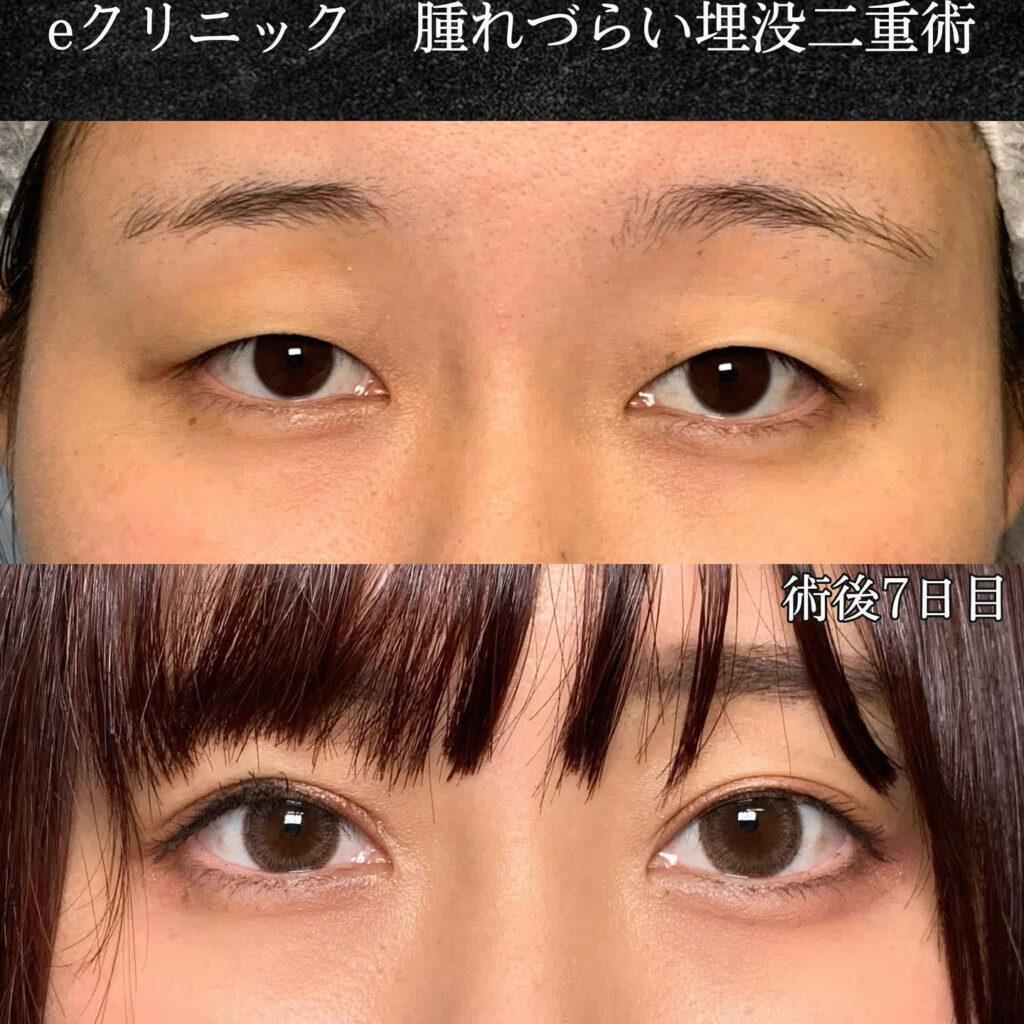 埋没法の症例写真