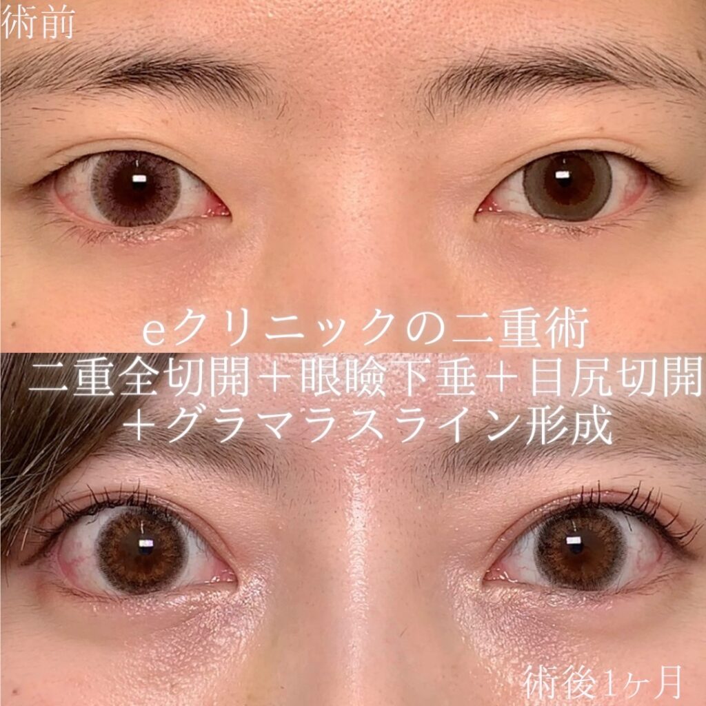 名古屋院のタレ目形成と全切開の症例