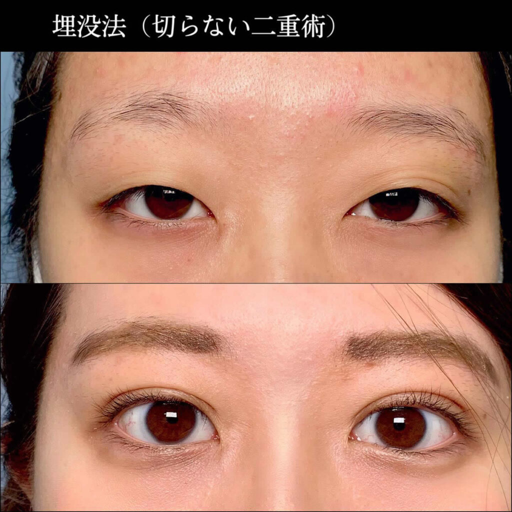 埋没法の症例写真