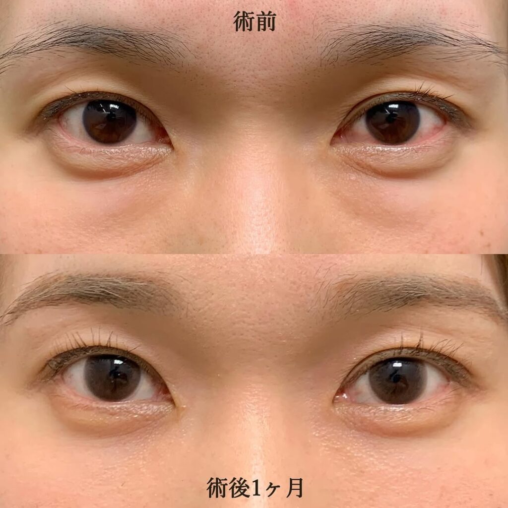 経結膜脱脂+脂肪注入