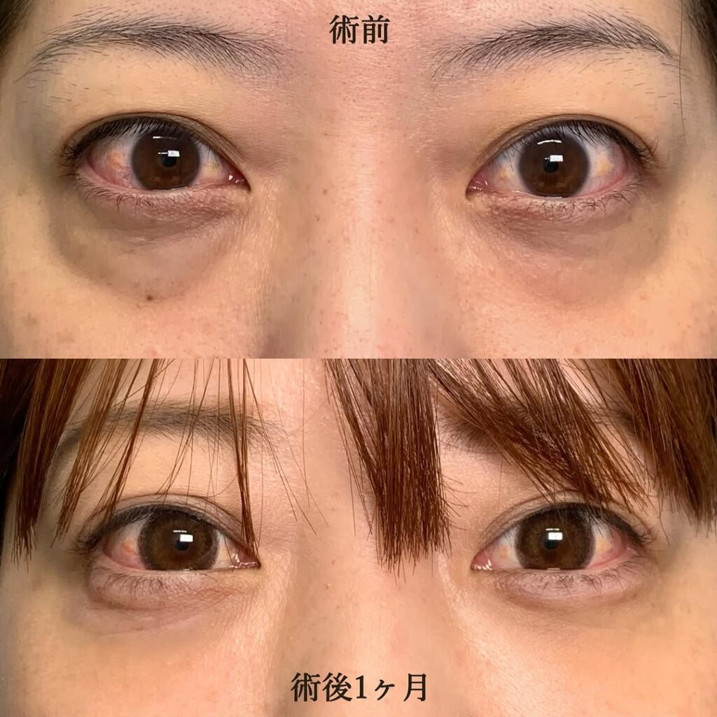 eクリニック大阪梅田院の経結膜脱脂＋脂肪注入
