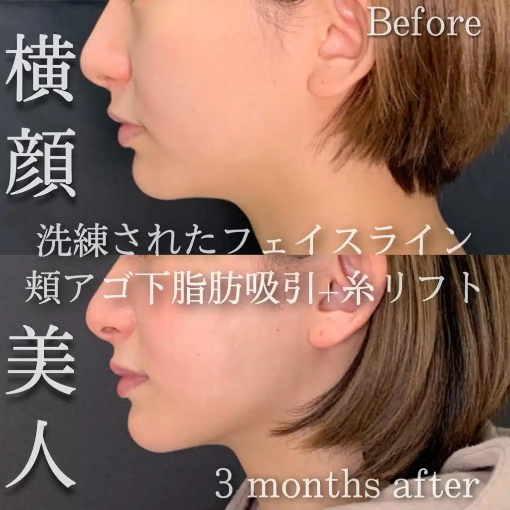 脂肪吸引