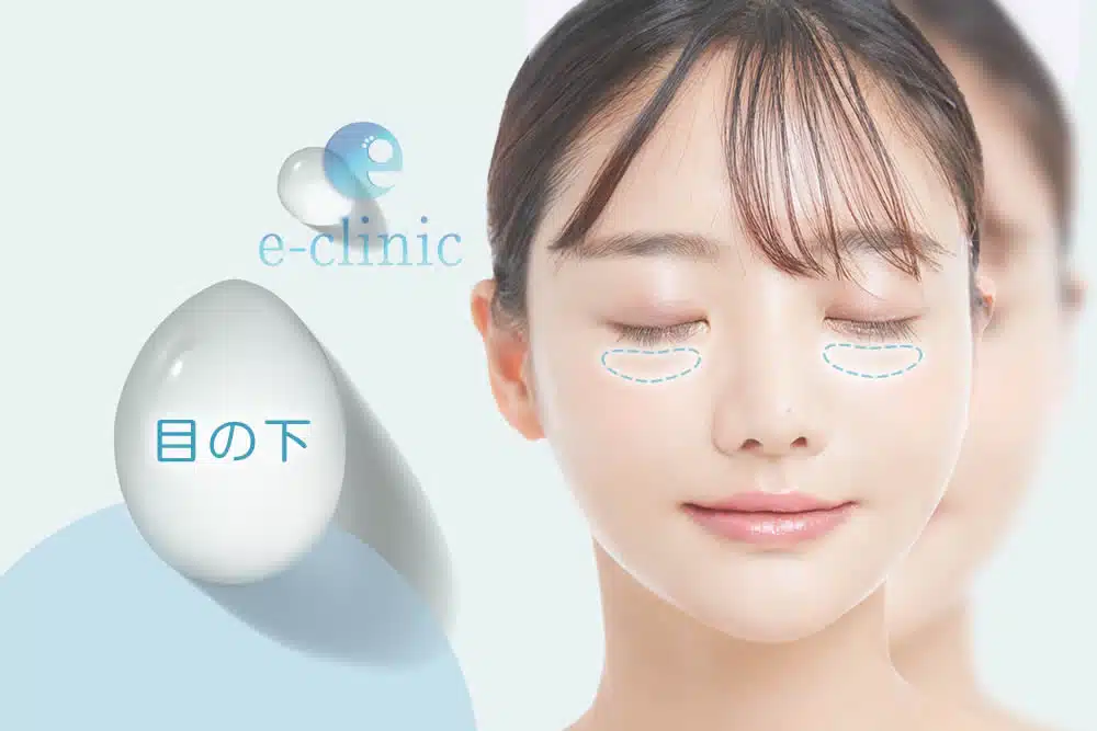 目の下　ヒアルロン酸