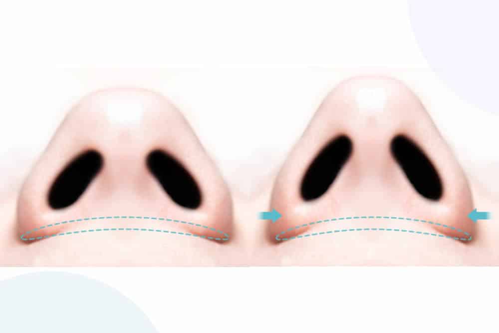 切らない小鼻縮小の施術図解