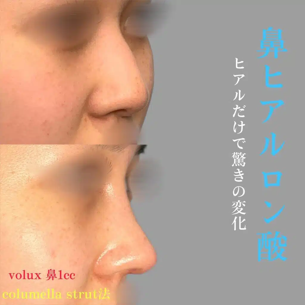 鼻　ヒアルロン酸