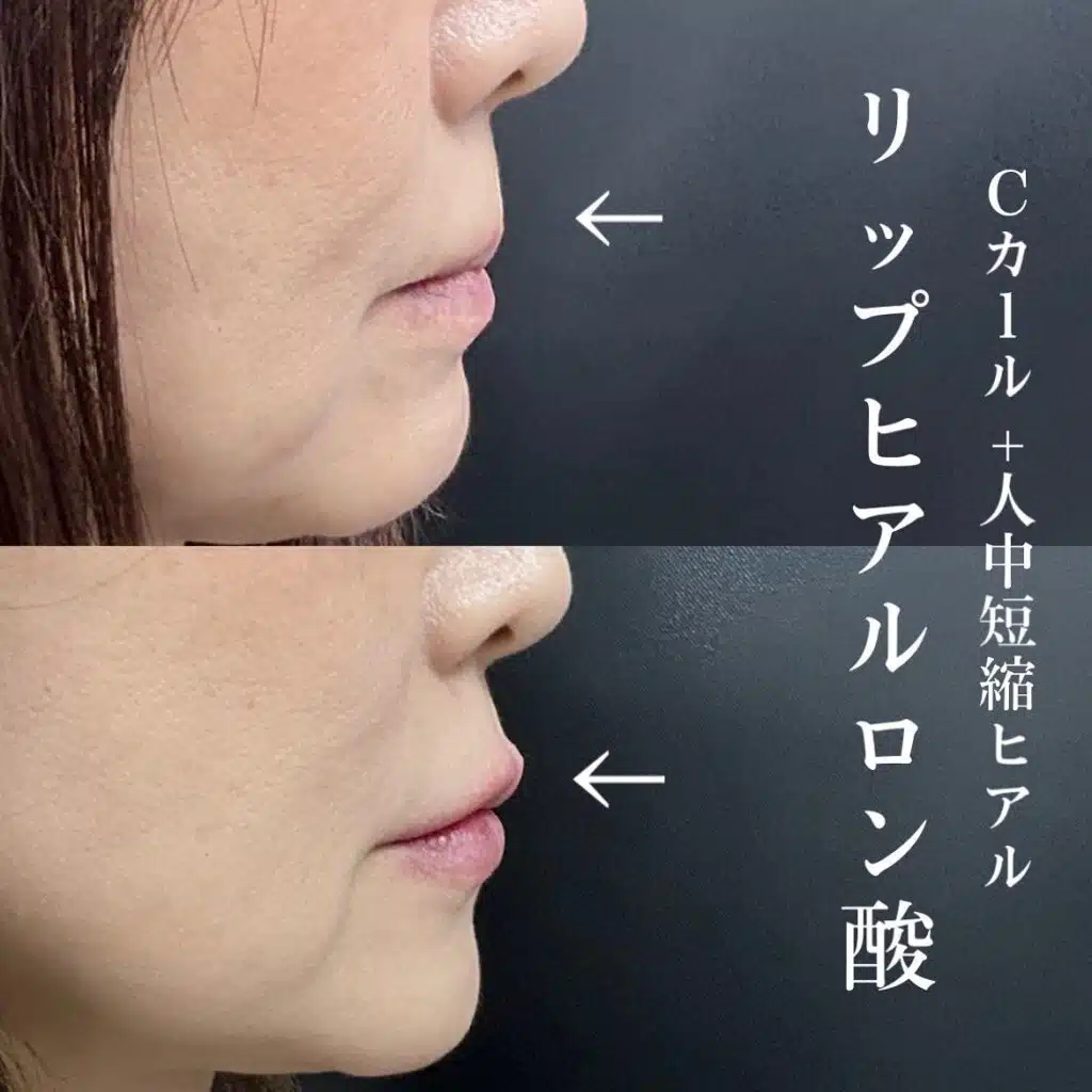 リップヒアルロン酸