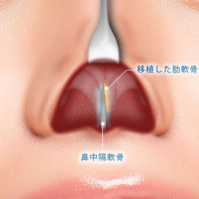 肋軟骨移植の鼻の中の解剖図