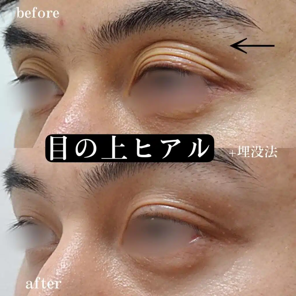 目の上　ヒアルロン酸