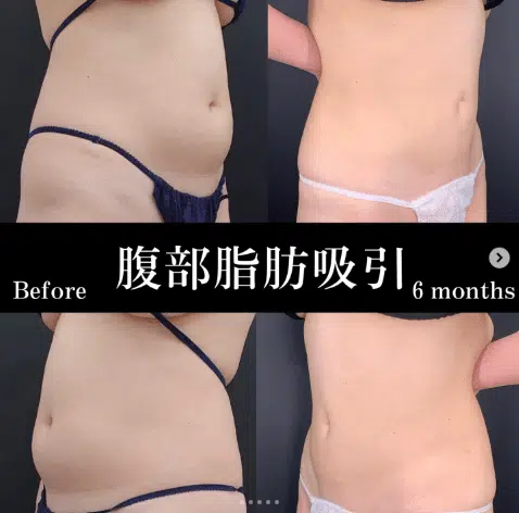脂肪吸引