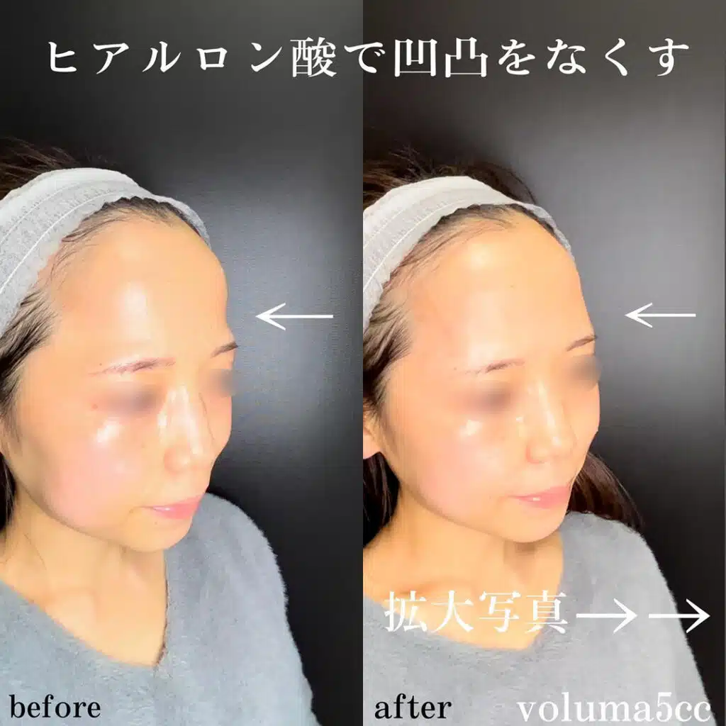 こめかみヒアルロン酸