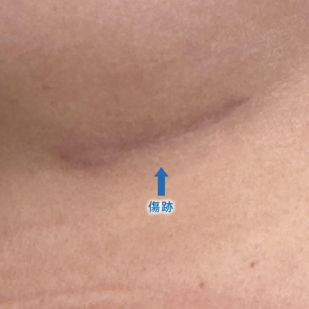 ６ヶ月後の肋軟骨の採取部分の傷跡