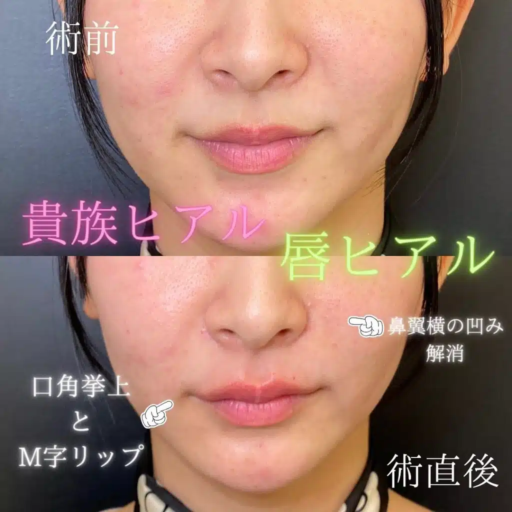 唇　ヒアルロン酸