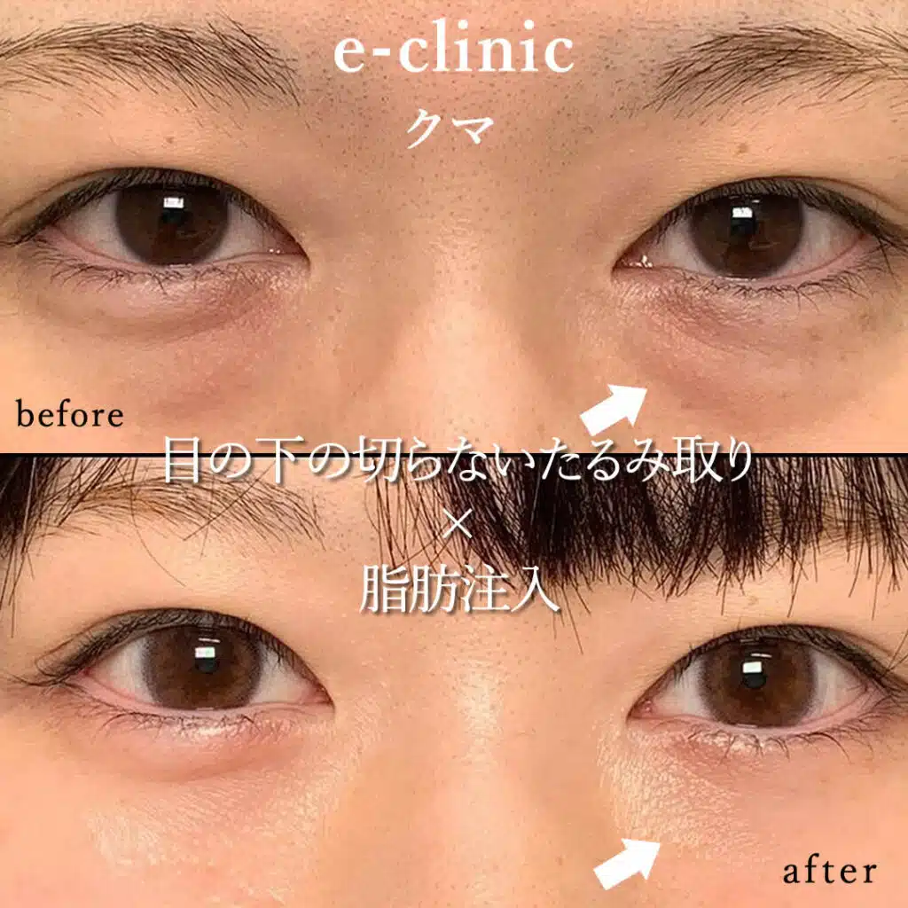 20代の目の下のクマ取りの症例写真