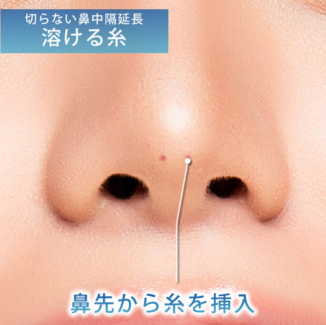 切らない鼻中隔延長の溶ける糸の刺入点の図解