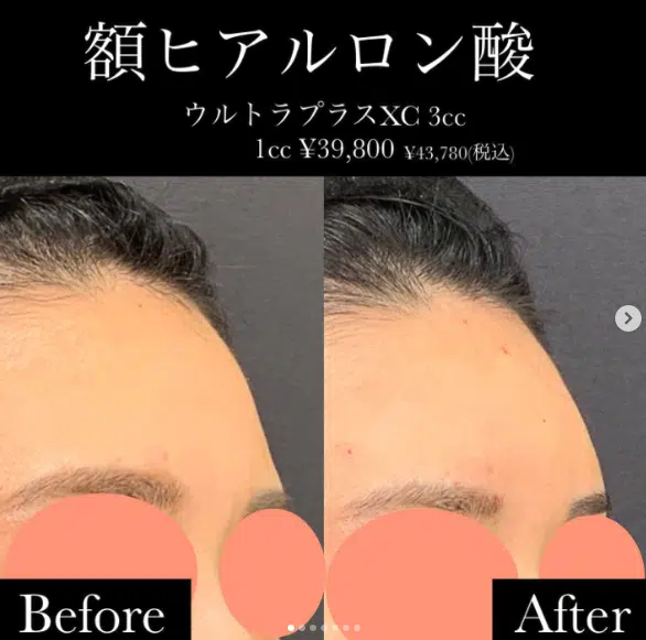 額　ヒアルロン酸