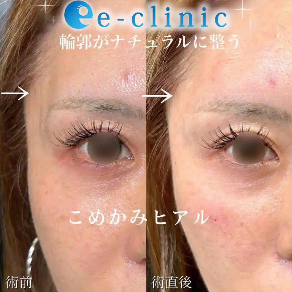 こめかみヒアル