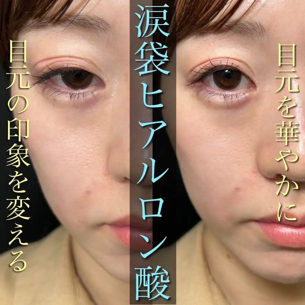 涙袋　ヒアルロン酸