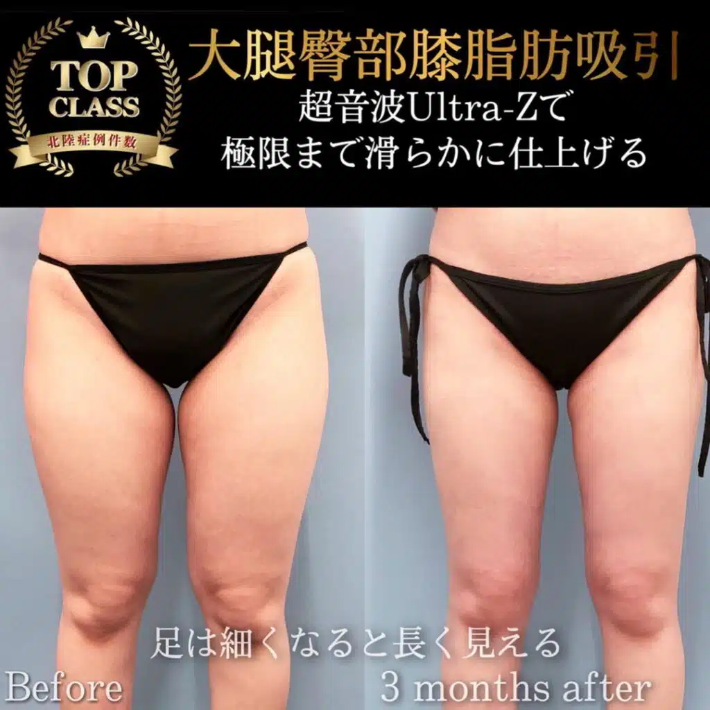 脂肪吸引