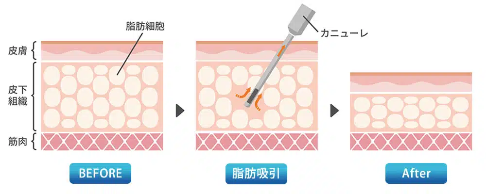 吸引の方法のたくさん脂肪を吸うテクニック