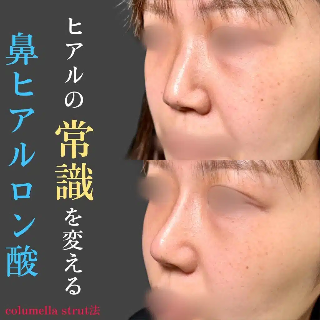 鼻　ヒアルロン酸