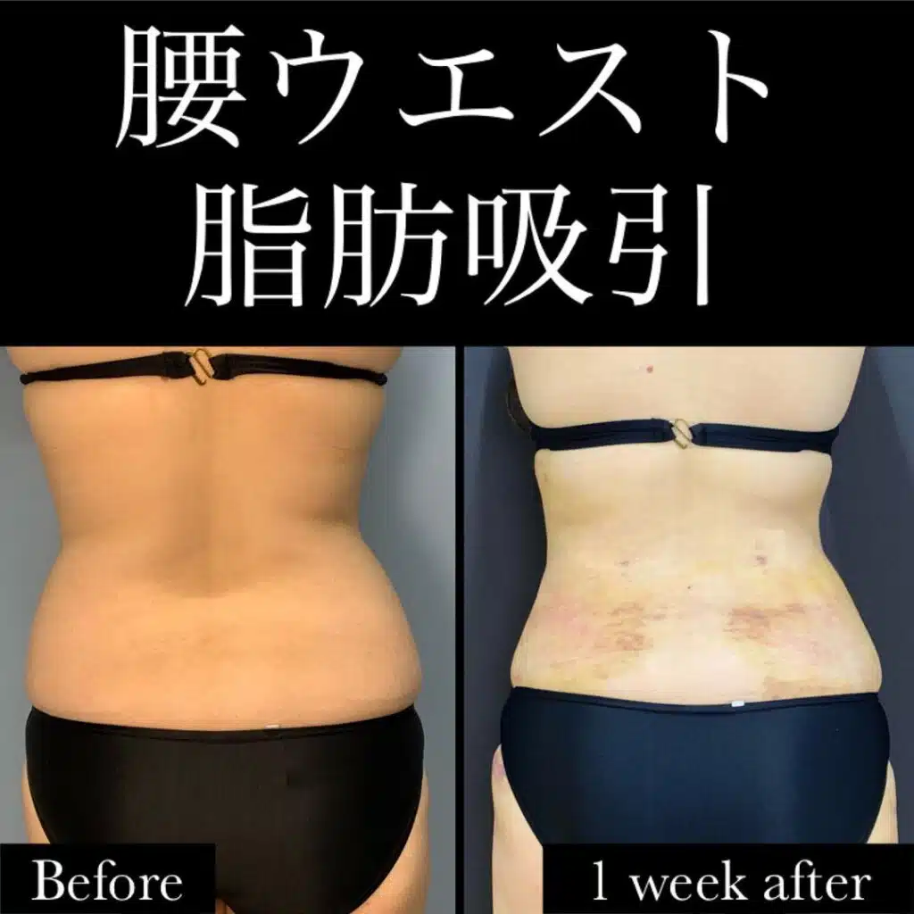 脂肪吸引