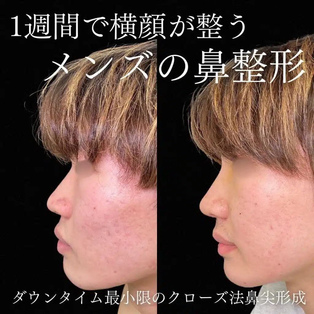 メンズ クローズ法鼻尖形成
