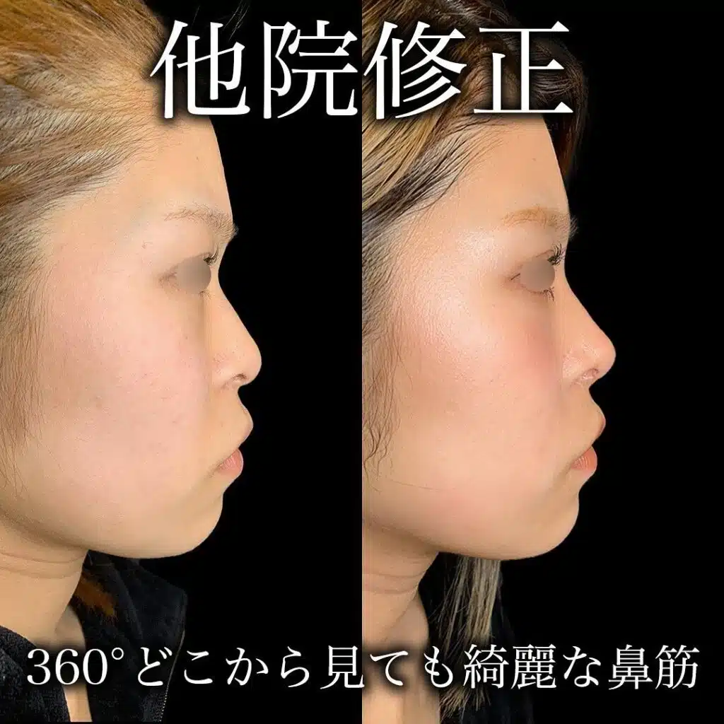 他院修正 鼻