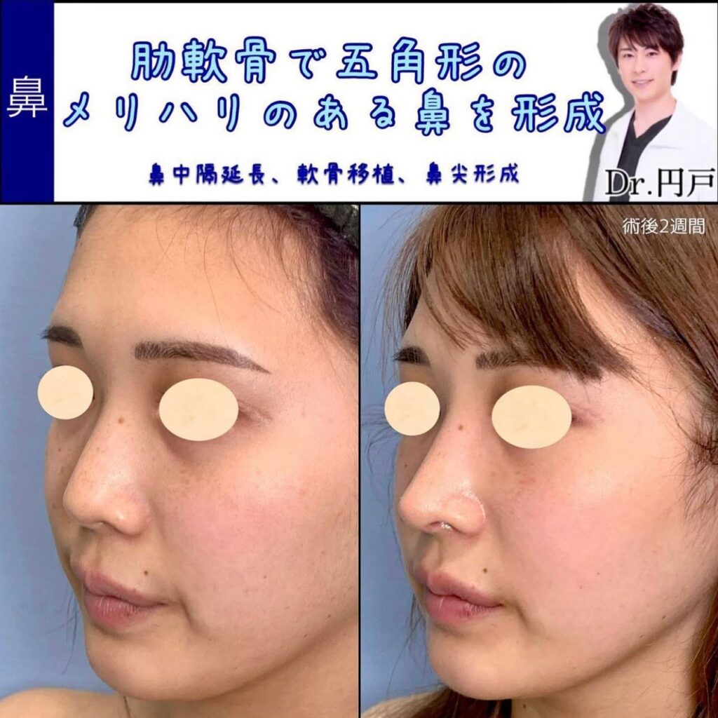 鼻中隔延長と軟骨移植と鼻尖形成の症例写真