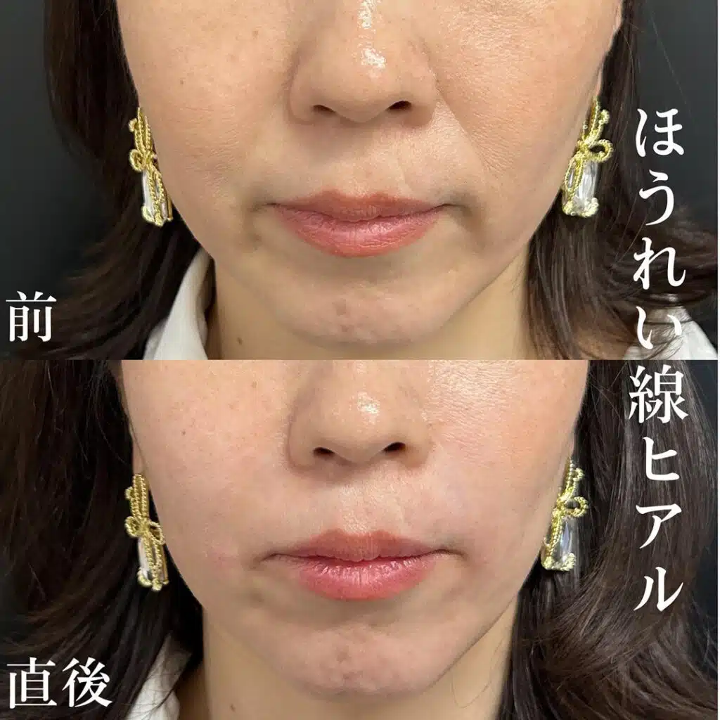 ほうれい線　ヒアルロン酸