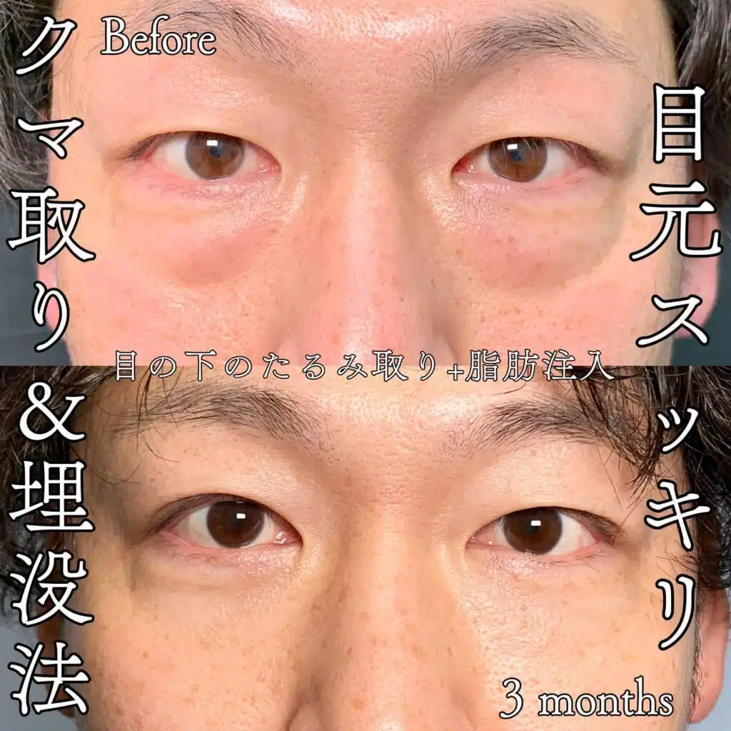 たるみ取り 脂肪注入