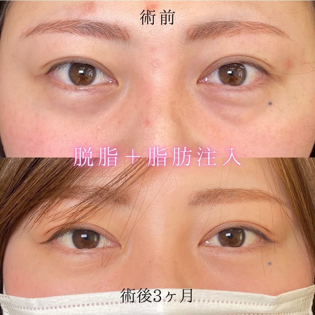 eクリニック大阪梅田院の経結膜脱脂の症例写真(5)