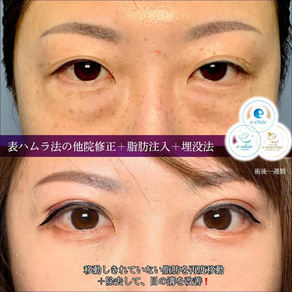 裏ハムラ法の他院修正と脂肪注入と埋没法の症例写真