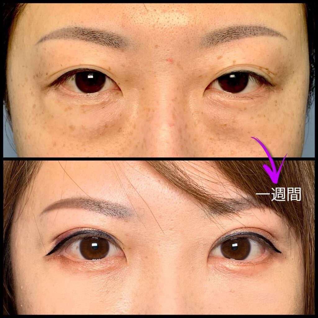 眼瞼下垂と全切開の傷跡の他院修正の１週間後の症例動画.