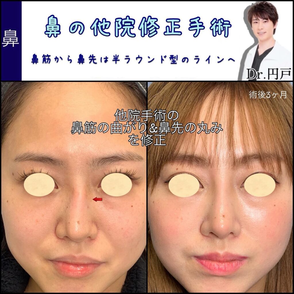 まがって沈んでしまった鼻先の他院修正の症例
