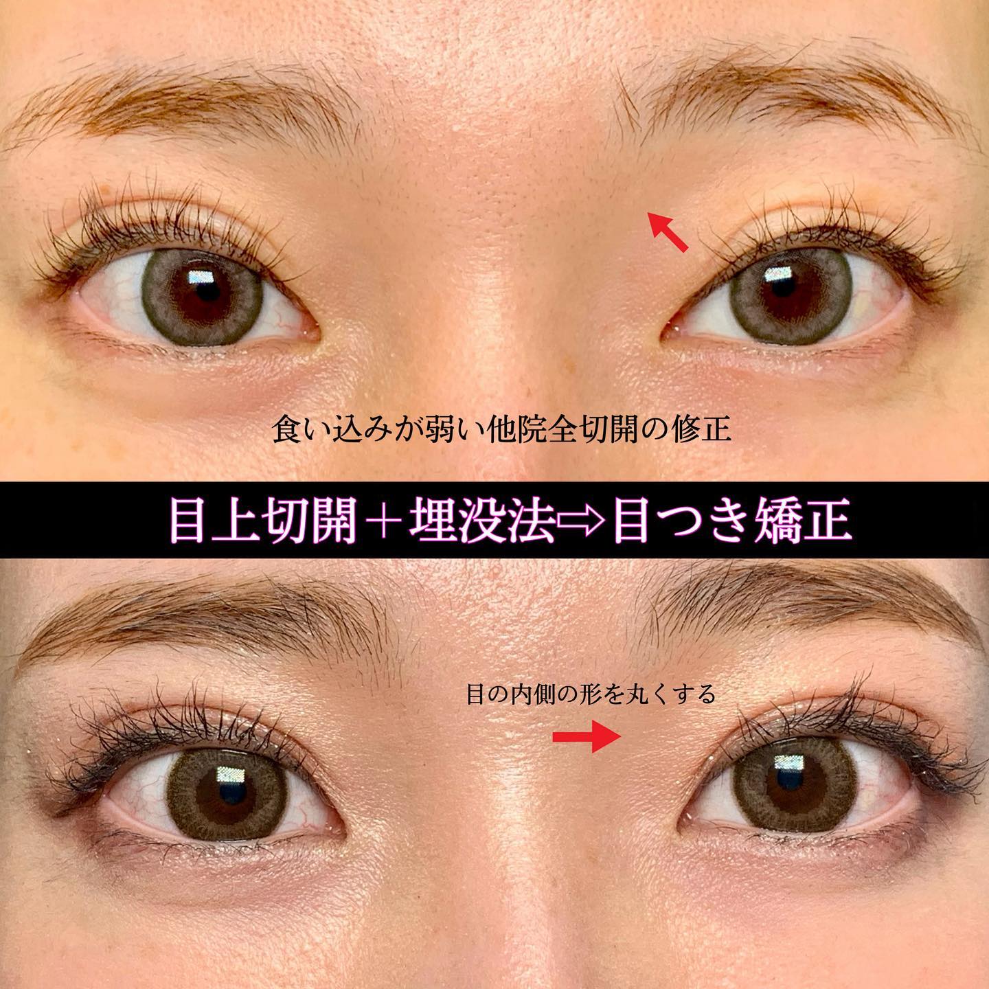 食い込みが弱い全切開の目つき矯正をした他院修正