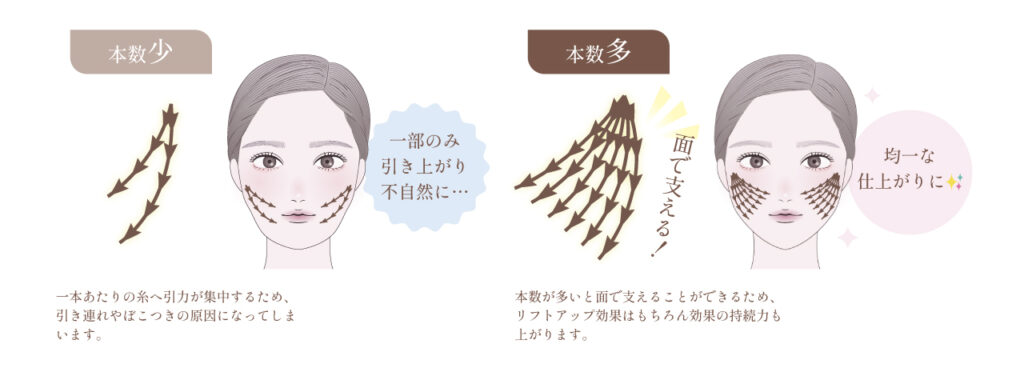 糸リフト