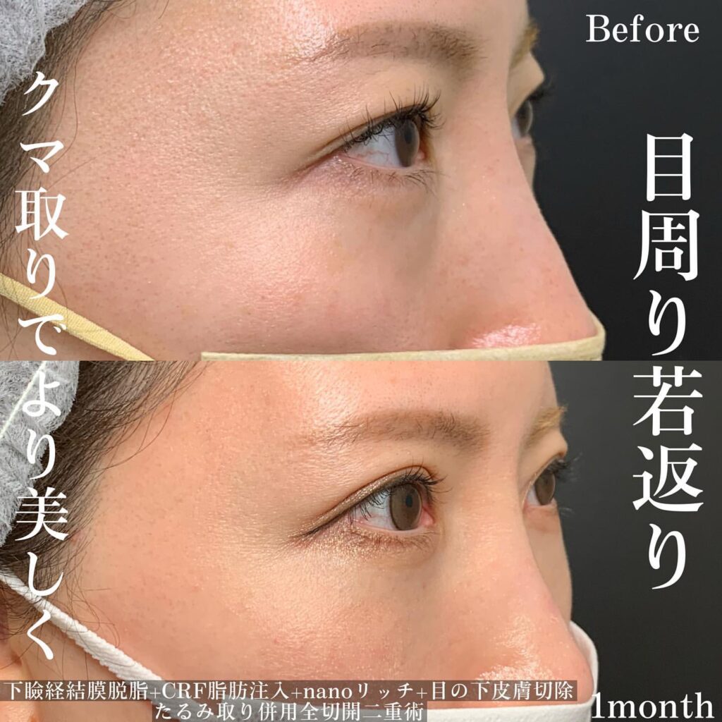 脱脂 全切開 脂肪注入 皮膚切除 たるみ取り