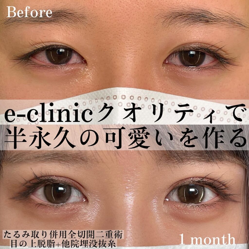 脱脂 全切開 他院埋没抜糸