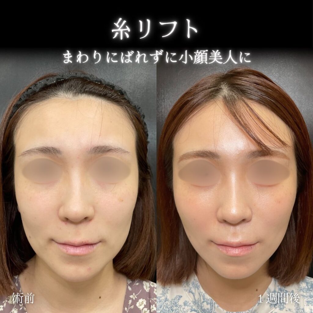 糸リフト