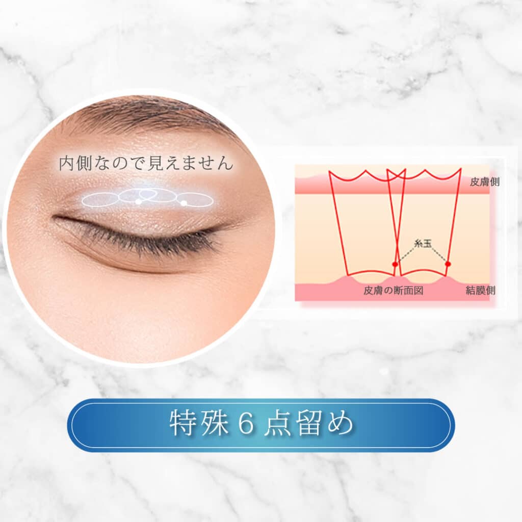 特殊6点留め