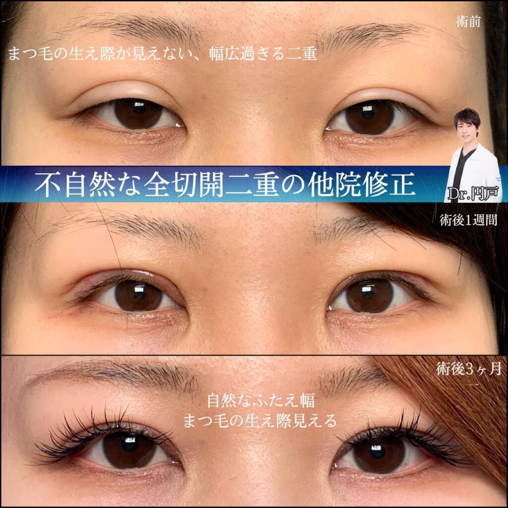 全切開 他院修正