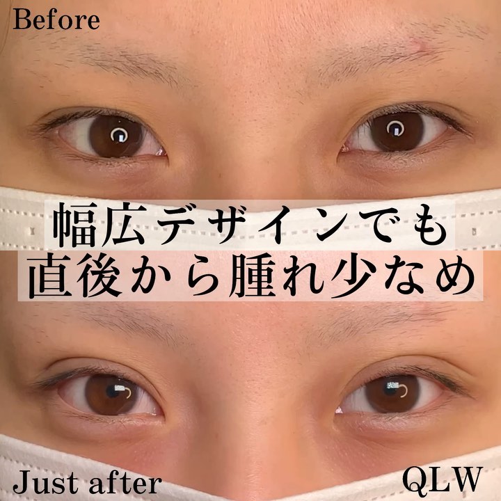 QLW