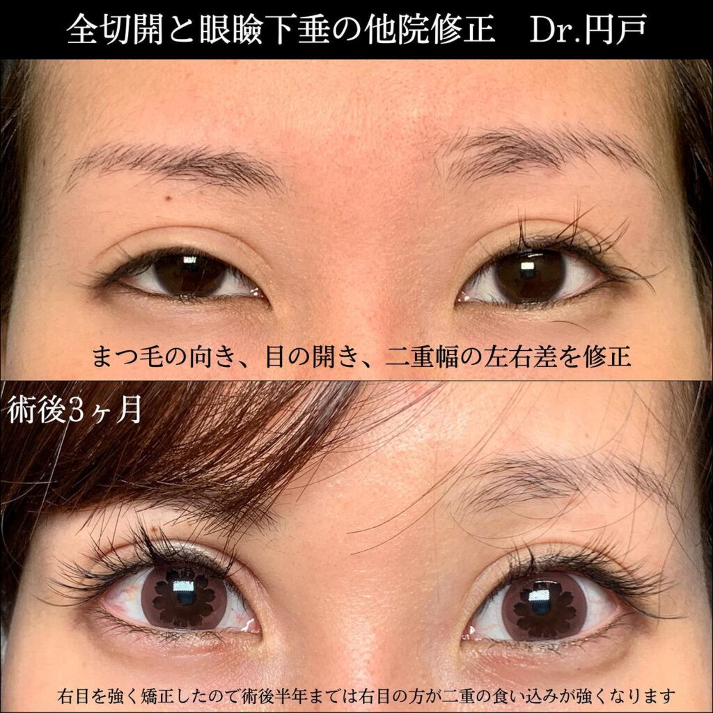 全切開 眼瞼下垂 他院修正