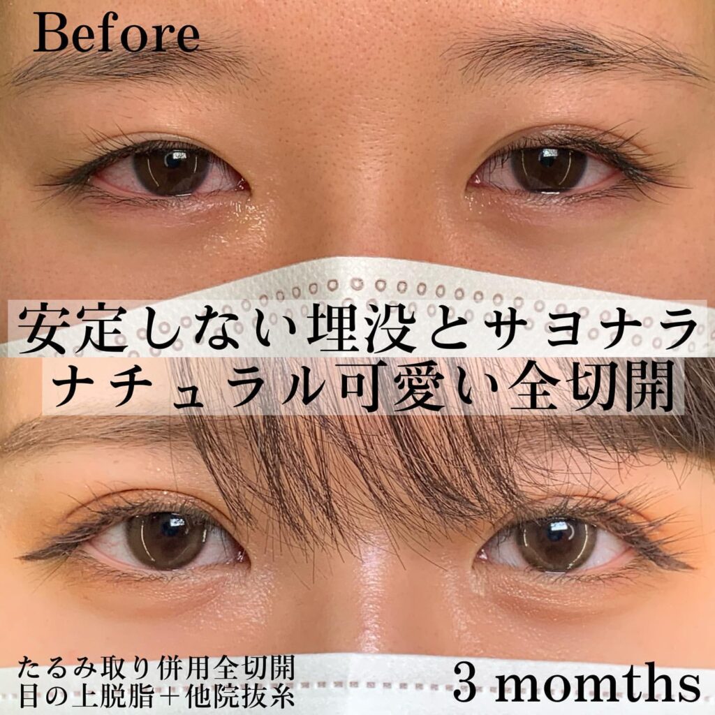 たるみ取り全切開 脱脂 他院抜糸