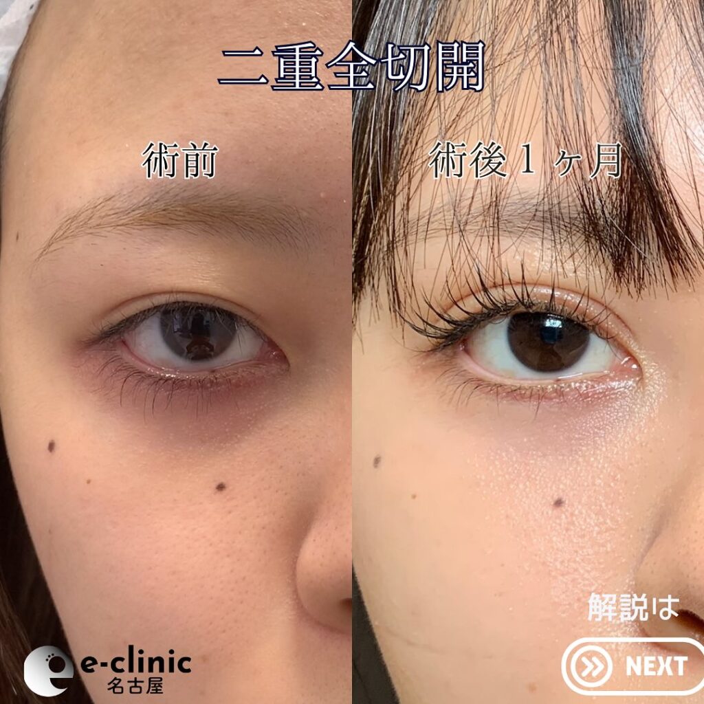 全切開