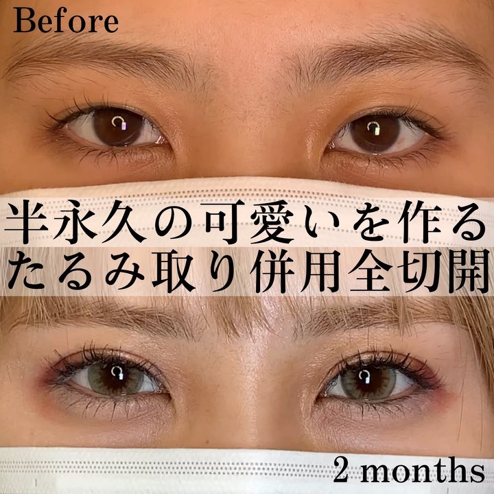 たるみ取り 全世界
