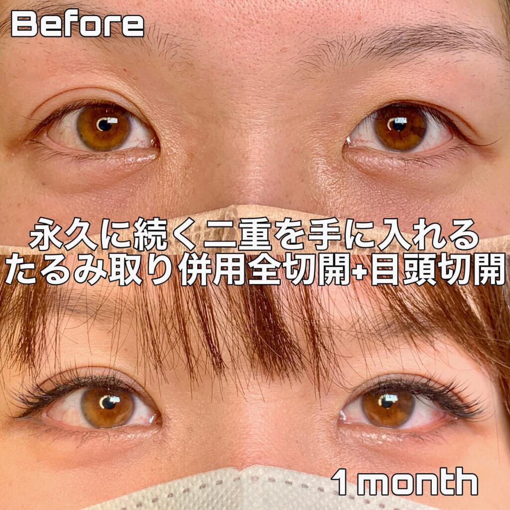 たるみ取り全切開 目頭切開