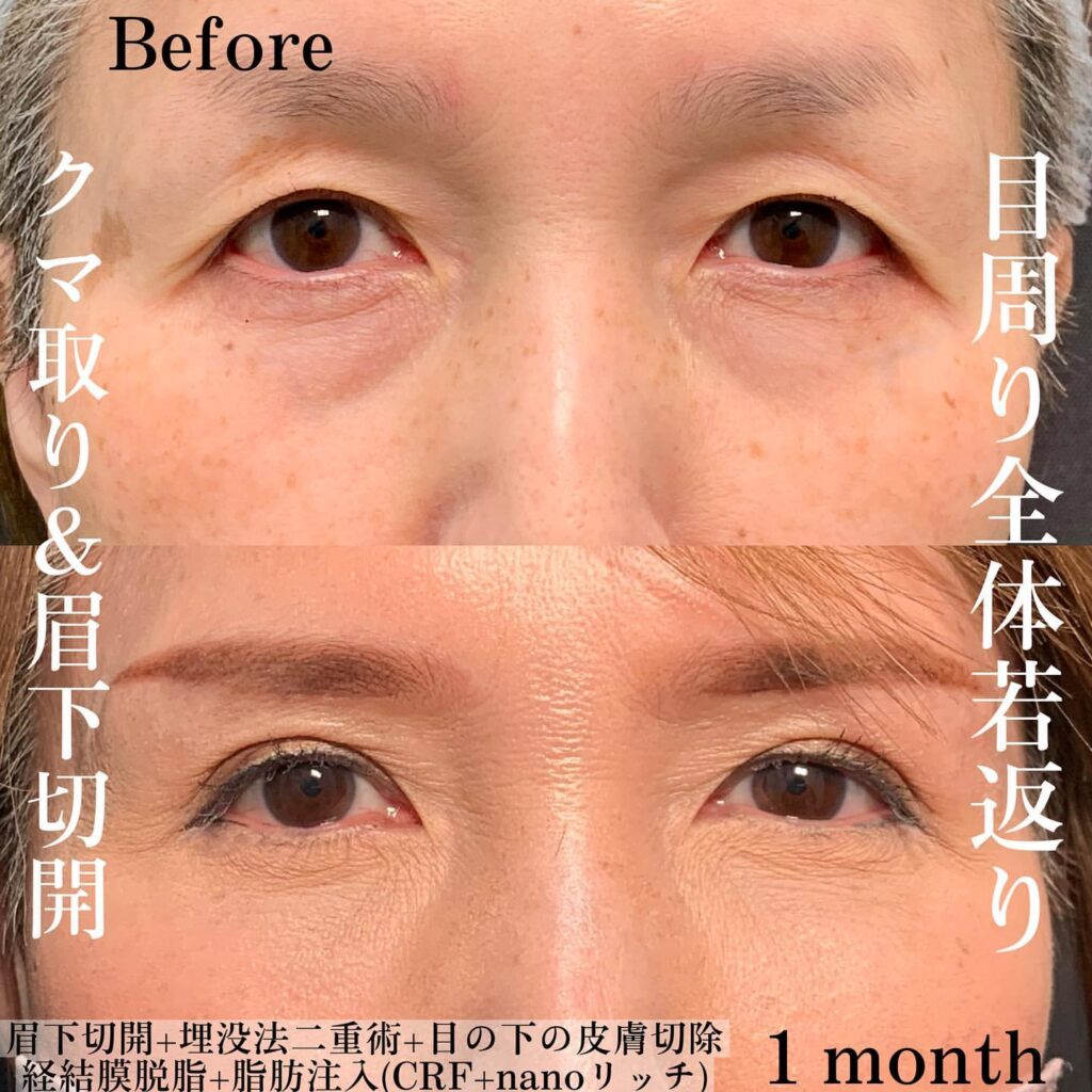 eクリニック大阪梅田院の経結膜脱脂と脂肪注入と埋没法と眉下切開の症例写真(4)