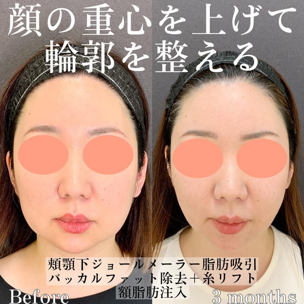 顎下の脂肪吸引とバッカルファット除去と糸リフトと脂肪注入の症例写真